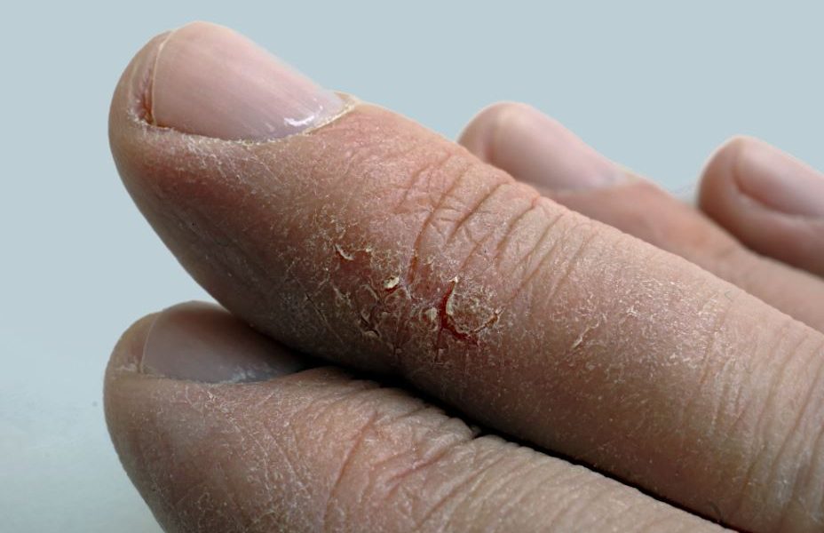 Problem suchej skóry na dłoniach